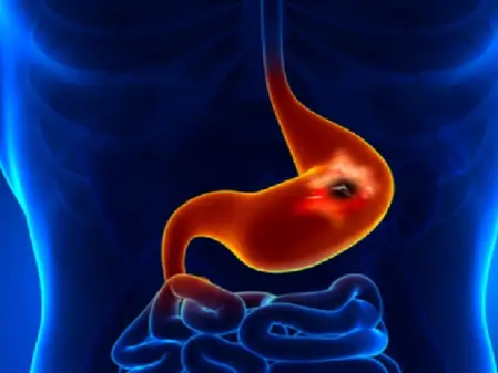 पेट-दर्द